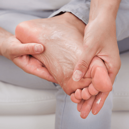 Person applying prescription strength antiperspirant to their feet to treat plantar hyperhidrosis