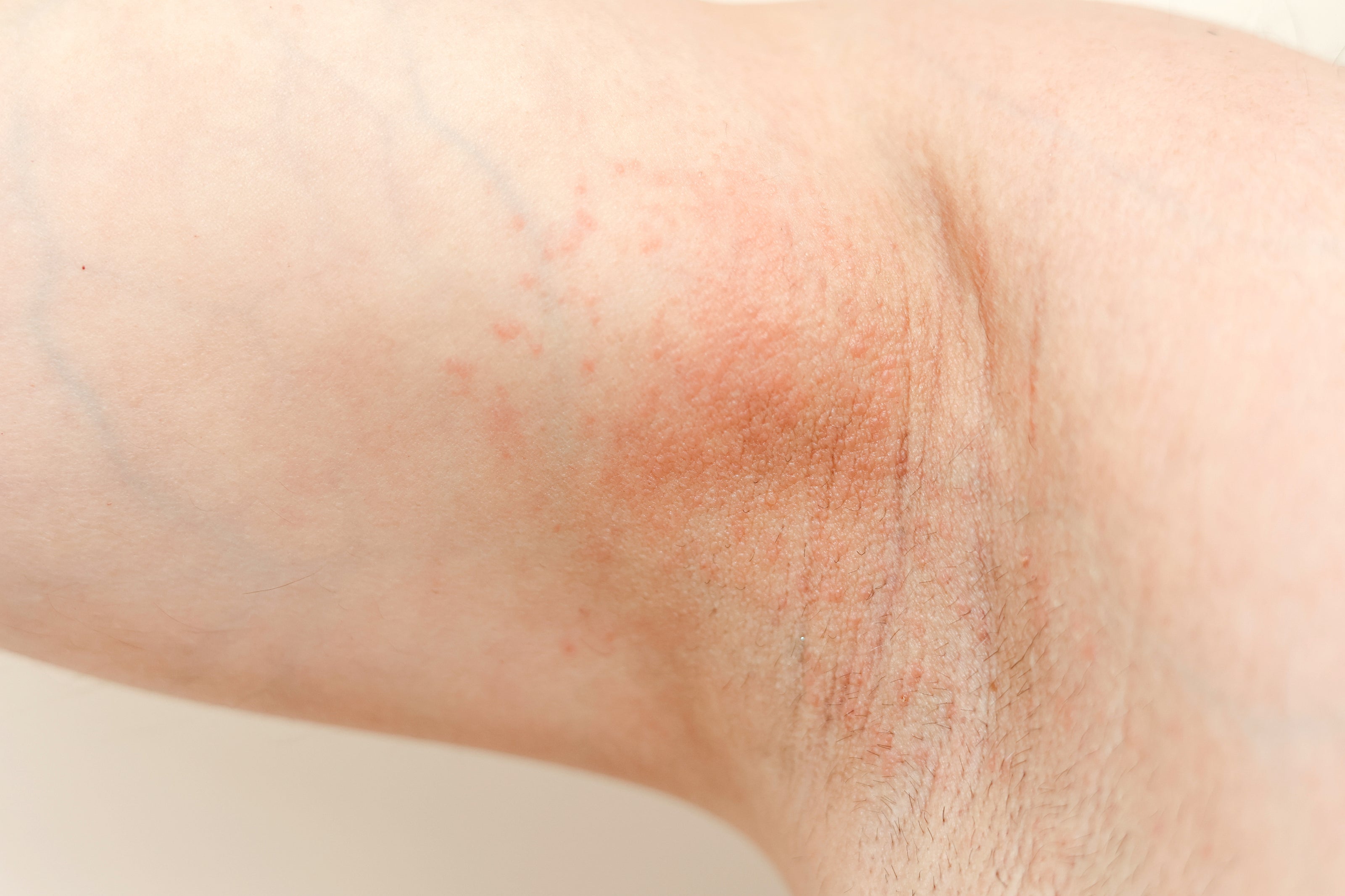 Irritated Underarms from Improper Use of Antiperspirants