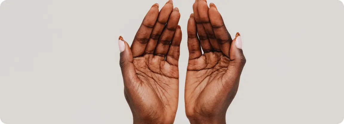 Woman with palmar hyperhidrosis