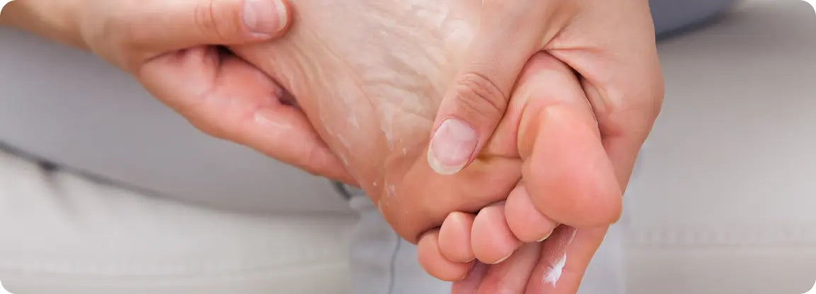 Person applying antiperspirant to their feet to treat plantar hyperhidrosis